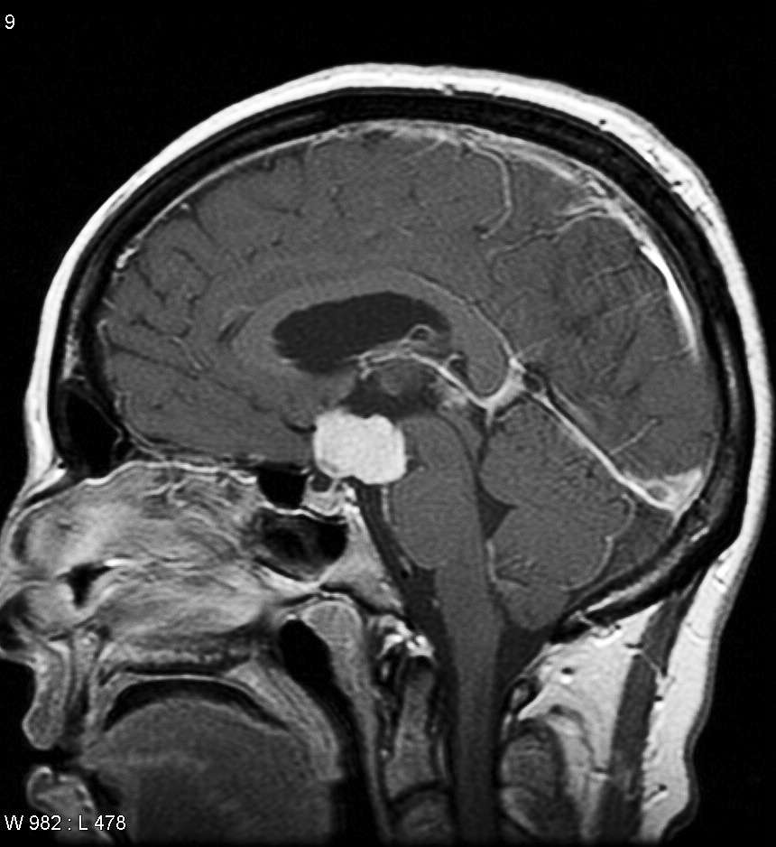 Craniopharyngioma example.